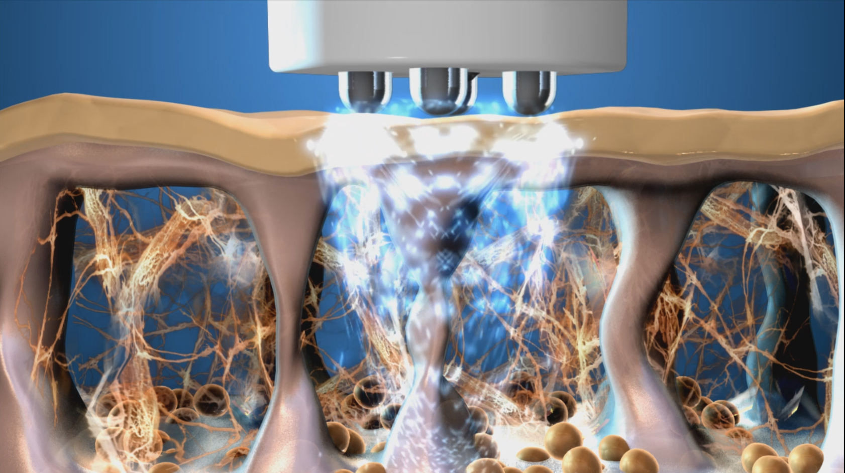 RF energy creates heat